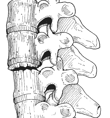 Holdsworth Fracture